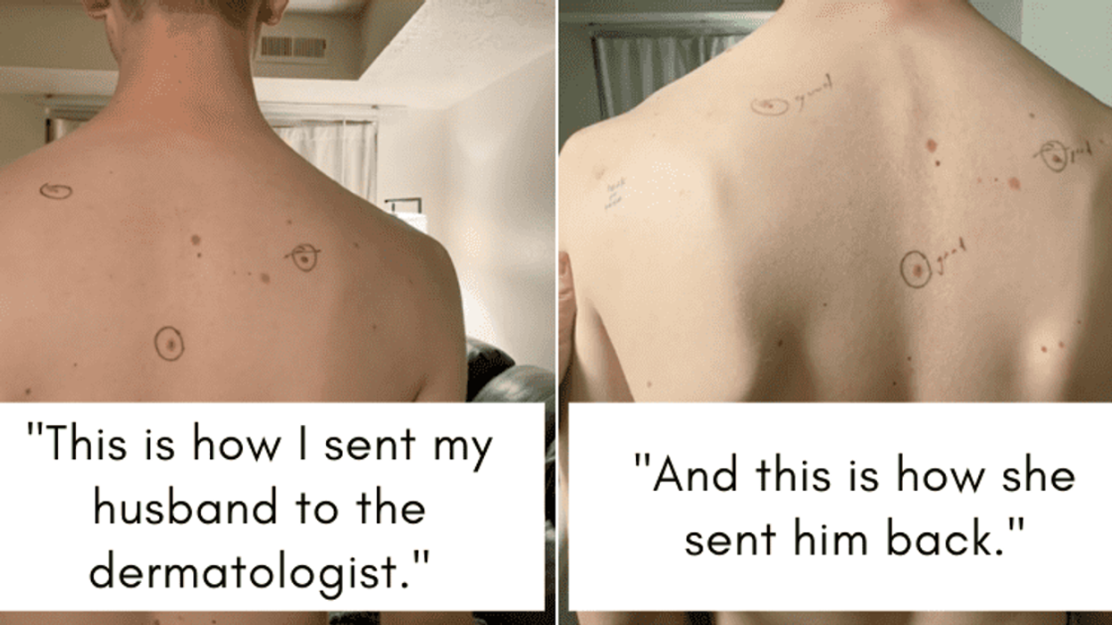 A man covered in the circles his wife drew on his skin, calling attention to his moles.